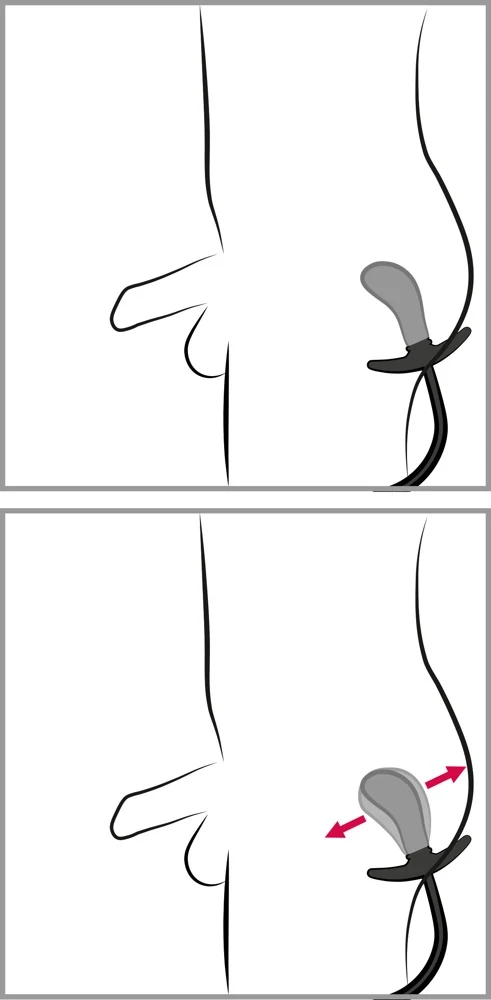 Inflatable Plug inner Metal Ba